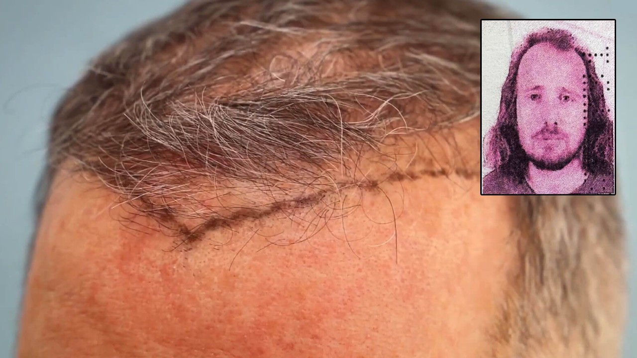 Saç ektirmek için geldi, hayatını kaybetti