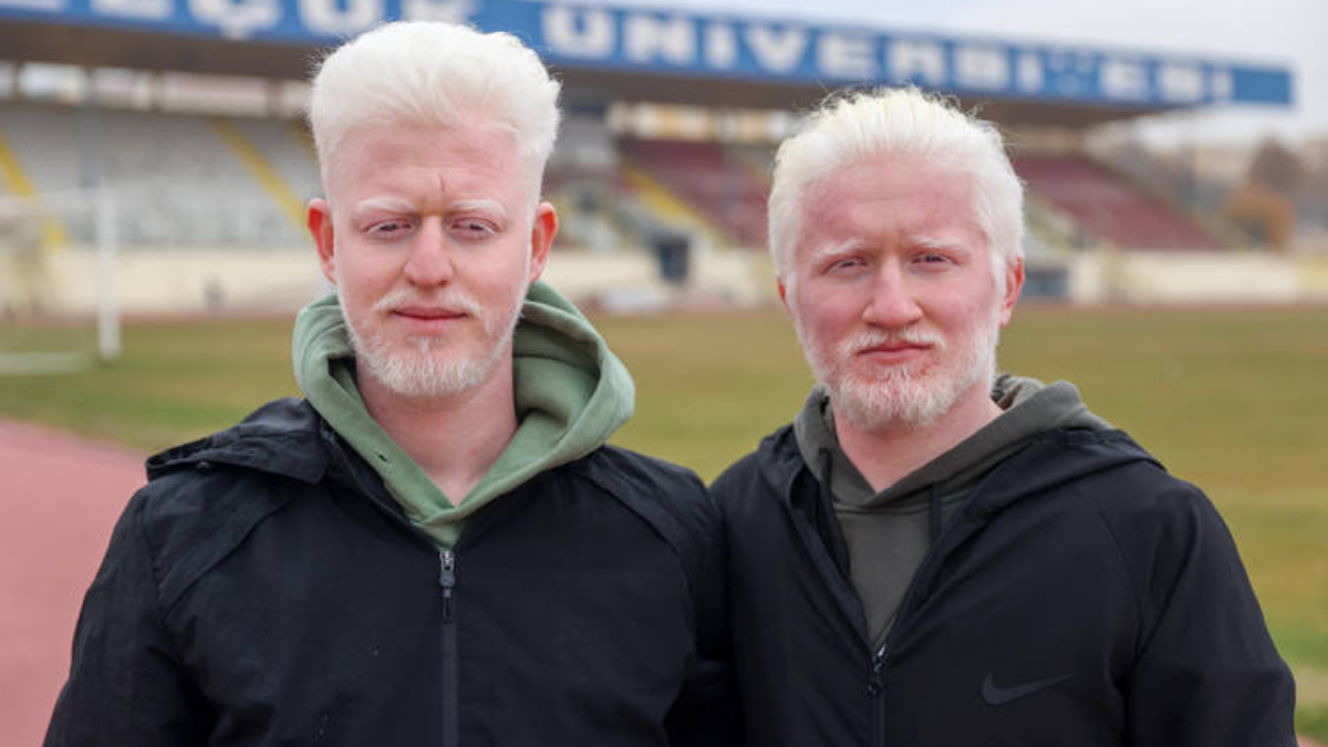 Albinizmli üniversite öğrencileri Muhammet ve Yusuf’un dayanışma hikâyesi